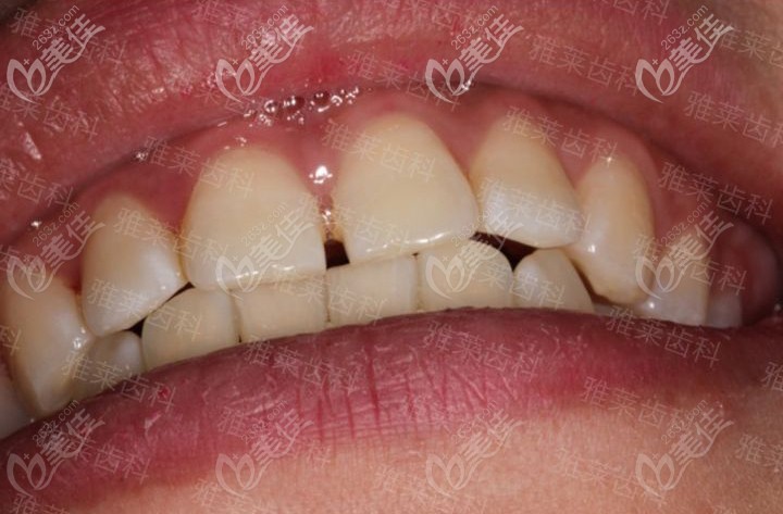 做隱適美矯正前