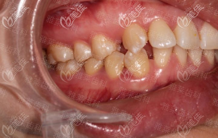 杭州雅萊紀(jì)亞梅時代天使矯正前