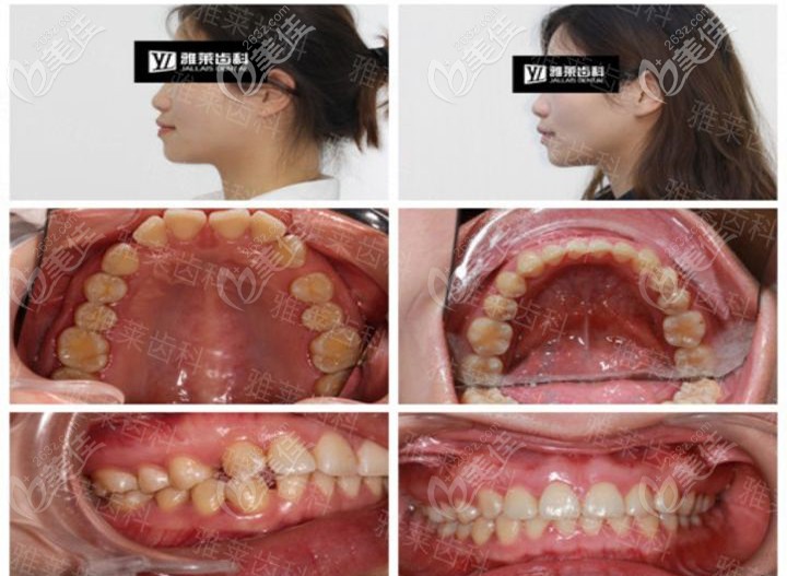 紀(jì)亞梅時代天使隱形矯正案例