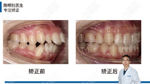 牙齒矯正效果對(duì)比