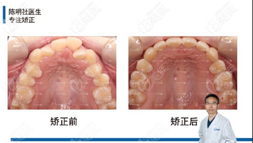 牙弓狹隘也有了明顯的擴(kuò)弓