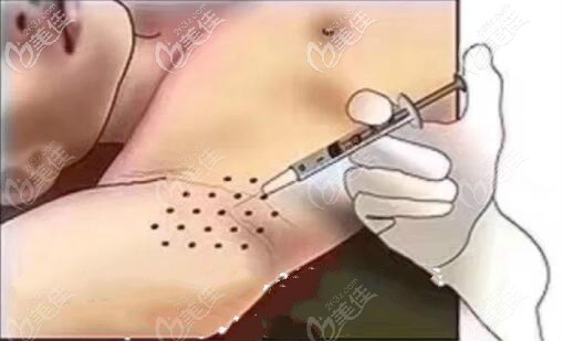 狐臭封閉針打在什么位置 狐臭封閉針打在什么位置