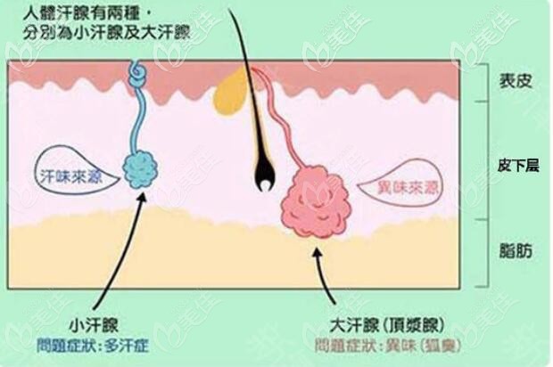 腋臭的形成原因 腋臭的形成原因