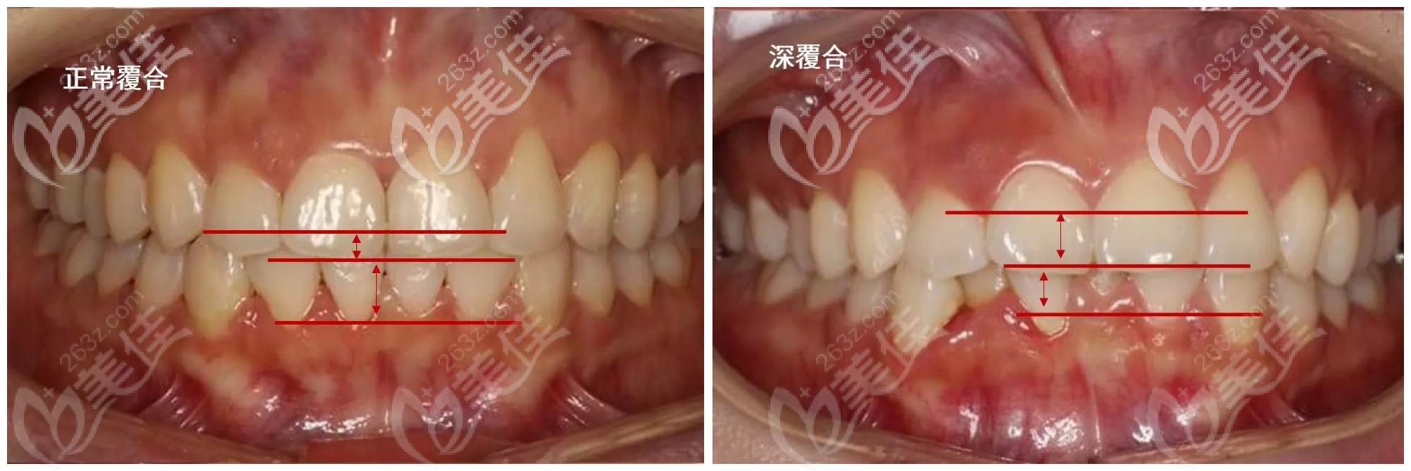 正常覆合和深覆合圖示 正常覆合和深覆合圖示