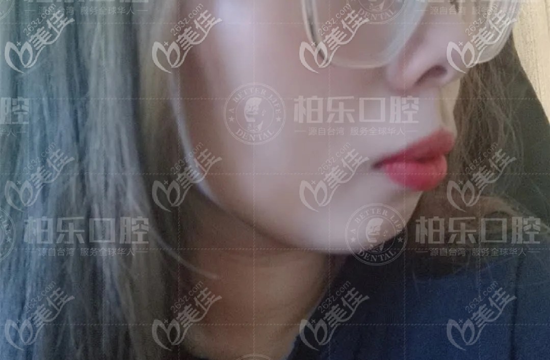 矯正前臉型 矯正前臉型