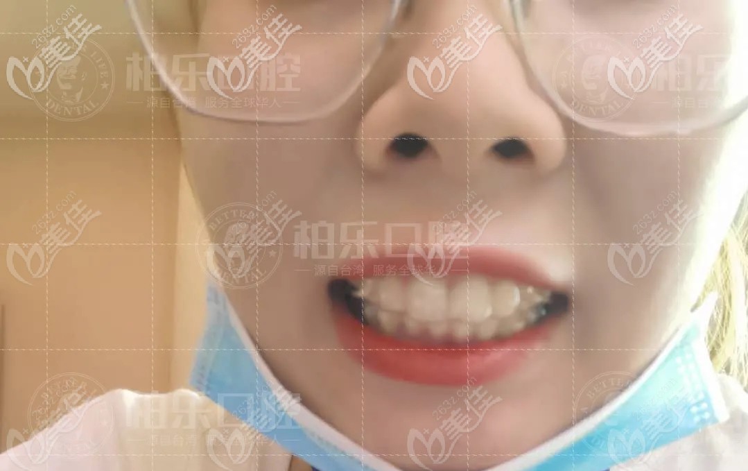 矯正中牙齒的樣子 矯正中牙齒的樣子