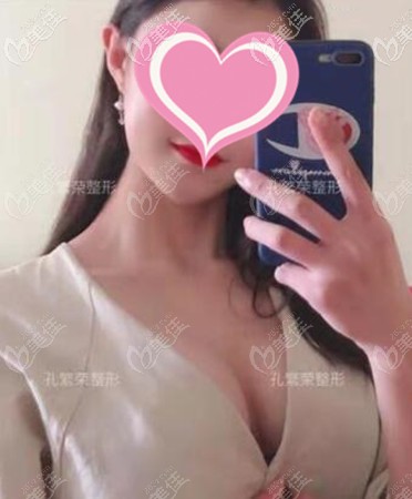 內(nèi)窺鏡隆胸術(shù)后真實(shí)感觸:放的曼托250cc手術(shù)沒想象中的疼