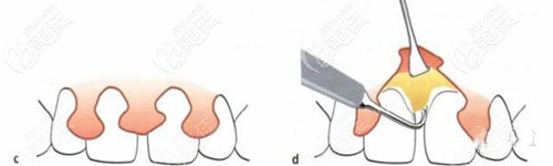牙周翻瓣術(shù)切口示意圖