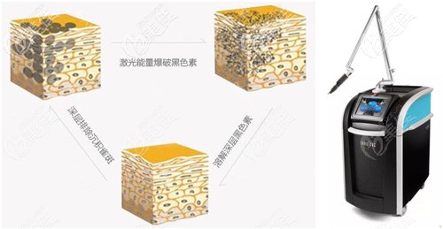 陶主任做激光祛斑的手術(shù)原理 陶主任做激光祛斑的手術(shù)原理