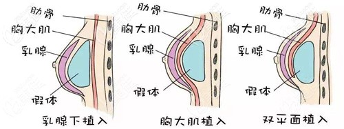 徐院長做假體隆胸的示意圖 徐院長做假體隆胸的示意圖
