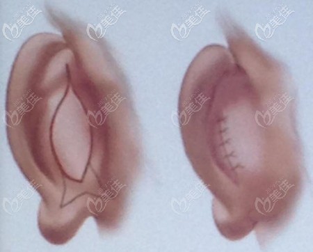招風(fēng)耳手術(shù)切口 招風(fēng)耳手術(shù)切口