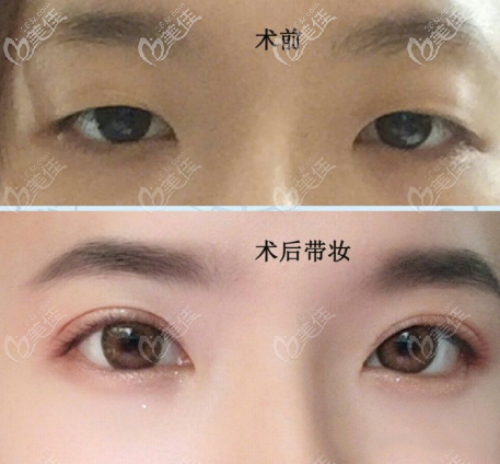 全切開7mm開扇雙眼皮效果圖