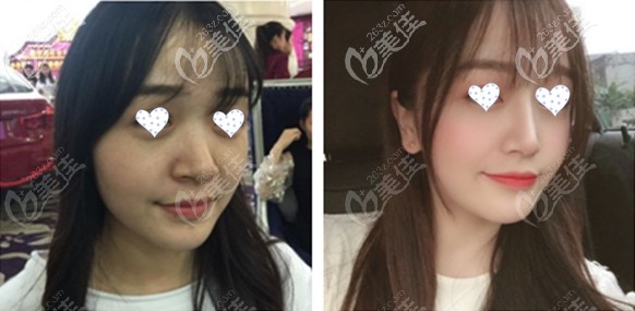 半肋綜合隆鼻效果圖