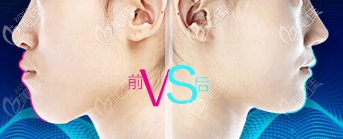 嘴巴前凸矯正1年半前后臉型變化對(duì)比.jpg 嘴巴前凸矯正1年半前后臉型變化對(duì)比.jpg