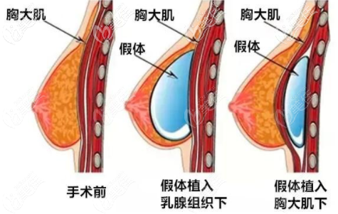 假體隆胸 假體隆胸