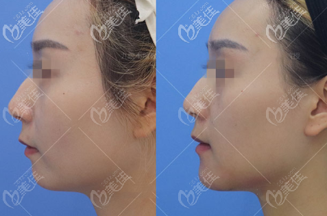 女士下頦成型手術(shù)側(cè)面對比照片