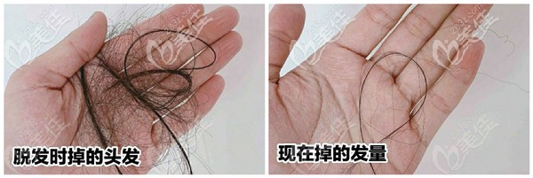 維生素b2和維生素b6治療脫發(fā)真實案例