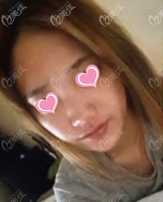 隆鼻術前照 隆鼻術前照