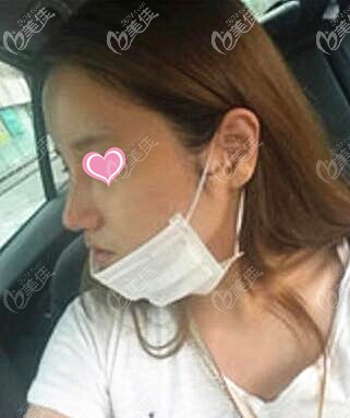 鼻綜合術后一周拆線效果 鼻綜合術后一周拆線效果