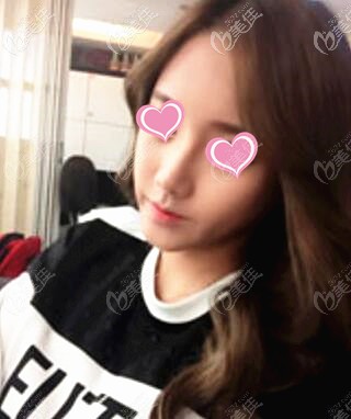 鼻綜合1個月效果照 鼻綜合1個月效果照