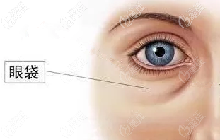 眼袋示意圖