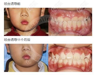 這是我家孩子6歲做地包天牙齒矯正的步驟和流程,戴的是羅慕咬合誘導(dǎo)矯正器