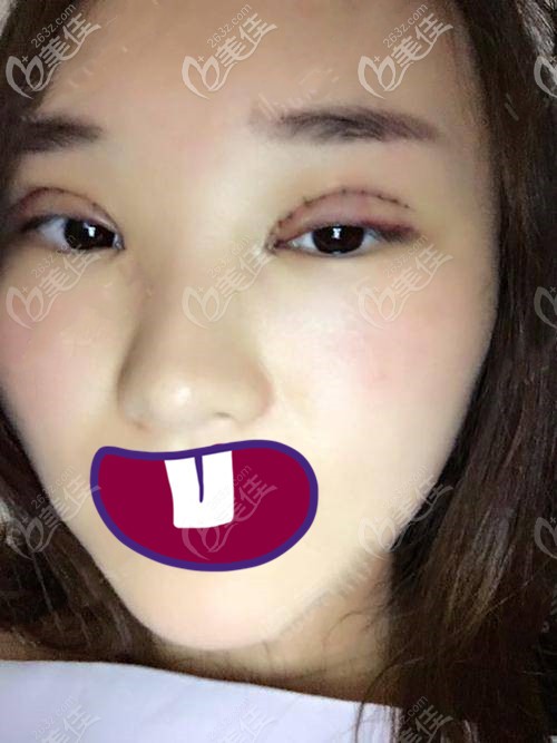 術(shù)后第五天 術(shù)后第五天