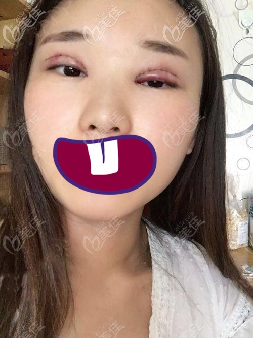 術(shù)后第二天眼睛情況 術(shù)后第二天眼睛情況