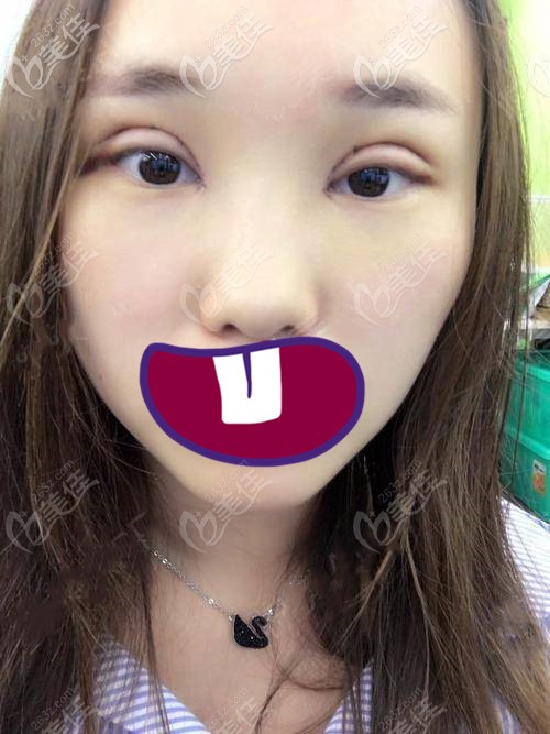 術(shù)后第七天 術(shù)后第七天