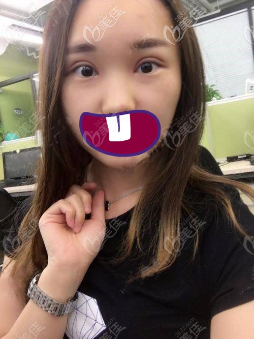 術(shù)后第20天 術(shù)后第20天