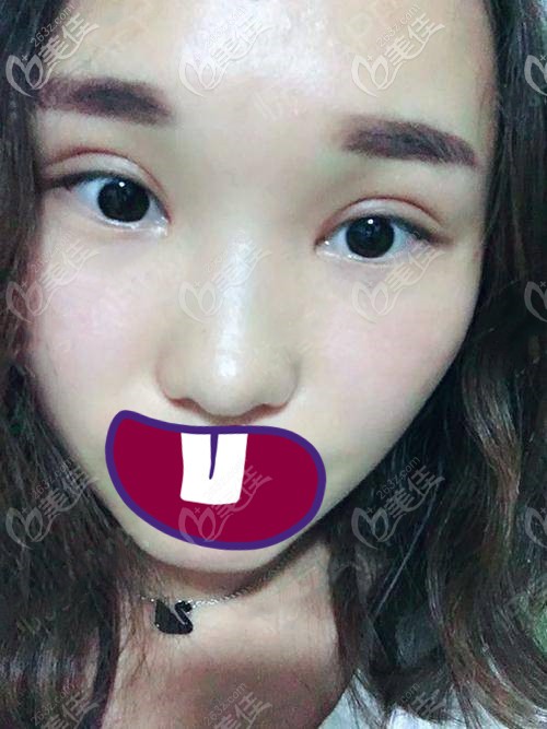 術(shù)后三個月 術(shù)后三個月