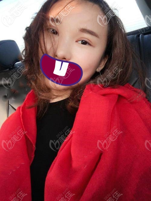 純個(gè)人分享:眼睛一大一小就真的別貼雙眼皮貼了,全切雙眼皮也能解決大小眼