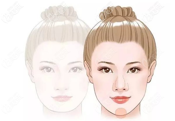 玻尿酸墊下巴 玻尿酸墊下巴