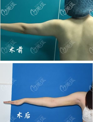 我手臂抽脂前后對(duì)比照片
