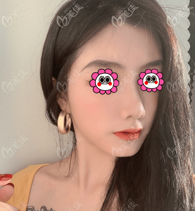 在北京做假體鼻綜合半個(gè)月