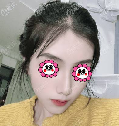 做鼻子有一個(gè)月了