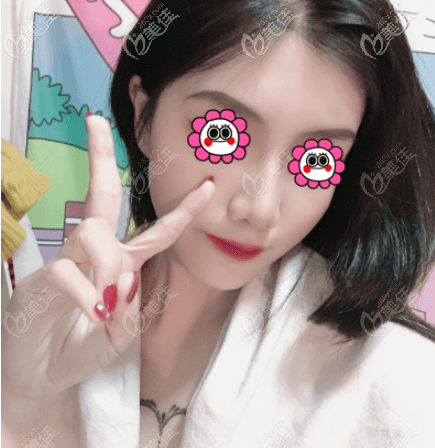 找王軍做硅膠假體鼻綜合沒(méi)有后遺癥感覺(jué)他做鼻子挺牛