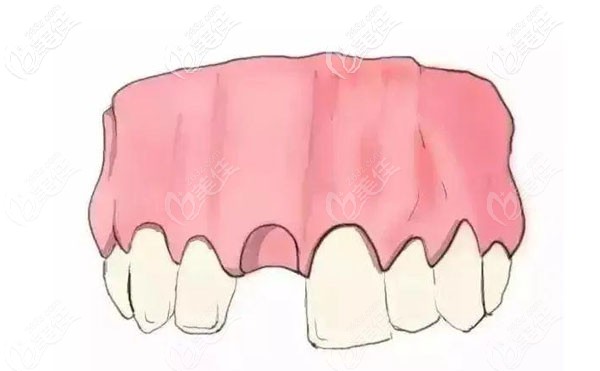 門牙種植牙需要多少錢一顆？6800元夠嗎