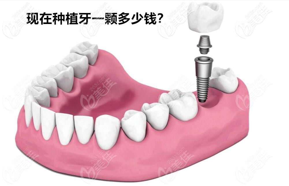 2021種植一顆牙多少錢 2021種植一顆牙多少錢