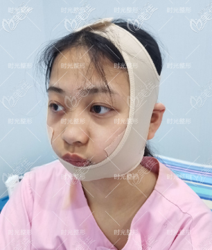 <!--<i data=20240703-sp></i>-->院長給我做完下頜角手術(shù)第二天 <!--<i data=20240703-sp></i>-->院長給我做完下頜角手術(shù)第二天