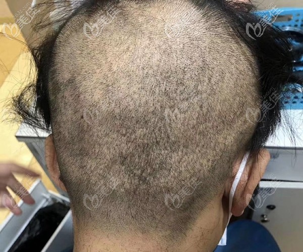 植發(fā)后取發(fā)地方都是坑