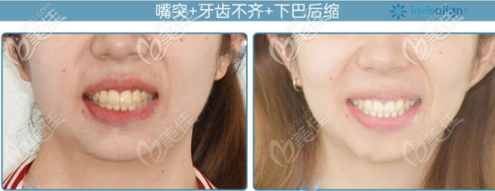 牙齒矯正前后對比照 牙齒矯正前后對比照