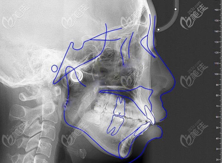 側(cè)臉X線片圖 側(cè)臉X線片圖