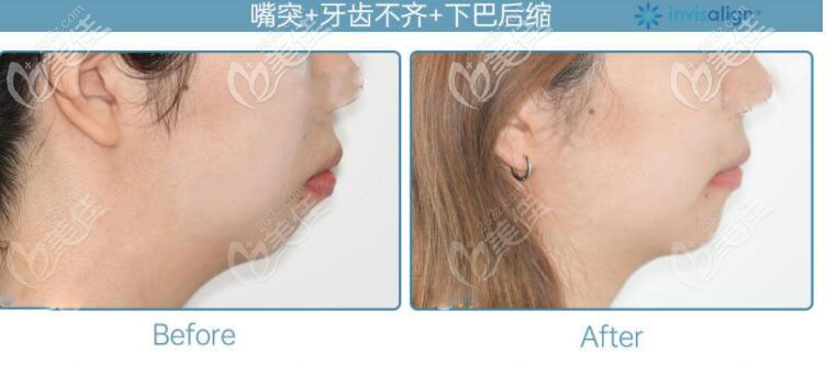 側(cè)臉變化圖 側(cè)臉變化圖