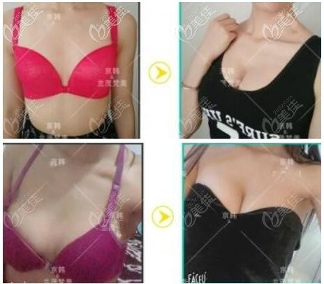 北京京韓脂肪豐胸真實實例療效對比圖