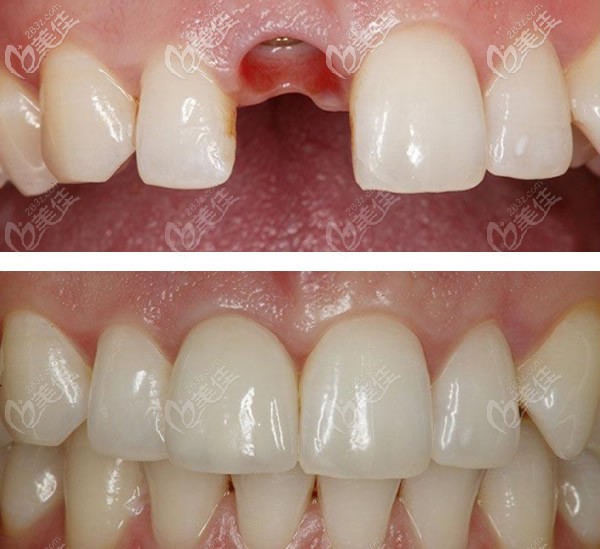 酒泉口腔醫(yī)院孫吉峰單顆牙缺失種植牙前后對比照片
