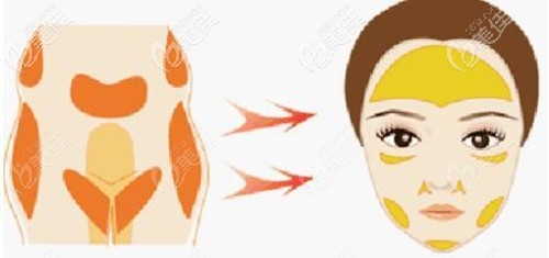 面部脂肪填充的部位