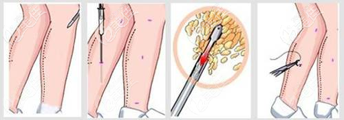 吸脂部位的傷口部位