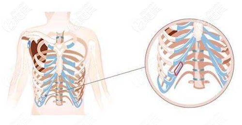 做肋軟骨耳再造取肋骨的地方