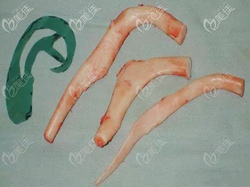 取出的肋軟骨材料